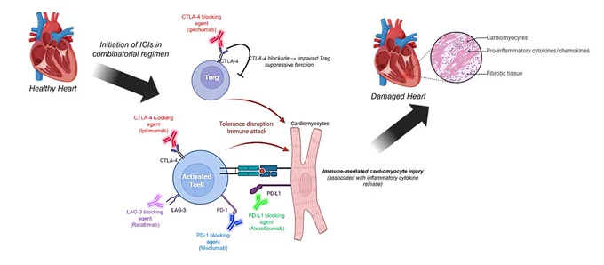 This translational study shows that triple immune checkpoint blockade triggers marked immune-mediated cardiomyocyte damage in a human co-culture model, exceeding single and dual ICIs. Strong cytokine release and inflammasome activation raise a clear alert for intensified cardio-oncology surveillance. What monitoring strategies make sense here?