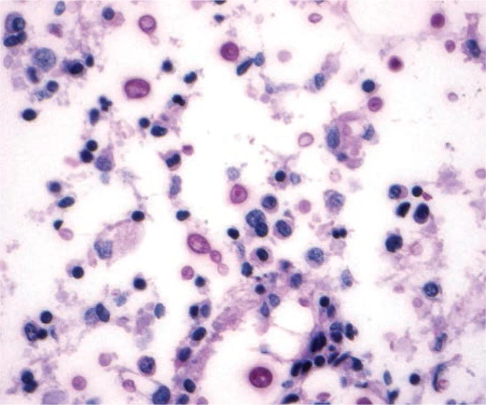 CRYPTOCOCCAL INFECTION IN BONE MARROW IN A PATIENT WITH HIV INFECTION:
Budding yeast are visible in the bone marrow biopsy. (PAS stain)