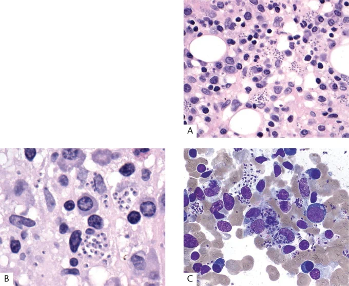 VISCERAL LEISHMANIASIS (KALA AZAR) INVOLVING THE BONE MARROW:
In the biopsy specimen, the organisms are intracellular within histiocytes and are often numerous (A,B). The dark nucleus and kinetoplast are visualized in the aspirate smear (C). (Courtesy of Dr. L. de Leval, Lausanne, Switzerland)