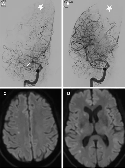 Figure. Reperfusion of proximal middle cerebral artery (MCA) results in minimal infarction.