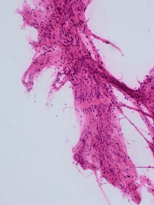 A tissue fragment composed of uniform spindle cells with nuclear palisading and areas without nuclei, creating Verocay bodies (in particular centrally) (H&E). @IARCWHO