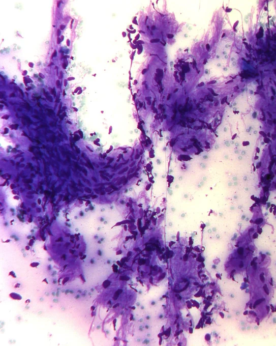Tissue fragments showing intertwining spindle cells in a net-like pattern with fibrillary stroma (Giemsa).