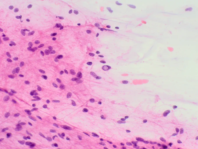 A tissue fragment with spindle cells with elongate, sometimes wavy nuclei in a fibrillary stroma. Nuclear inclusions are a common finding (H&E). @IARCWHO