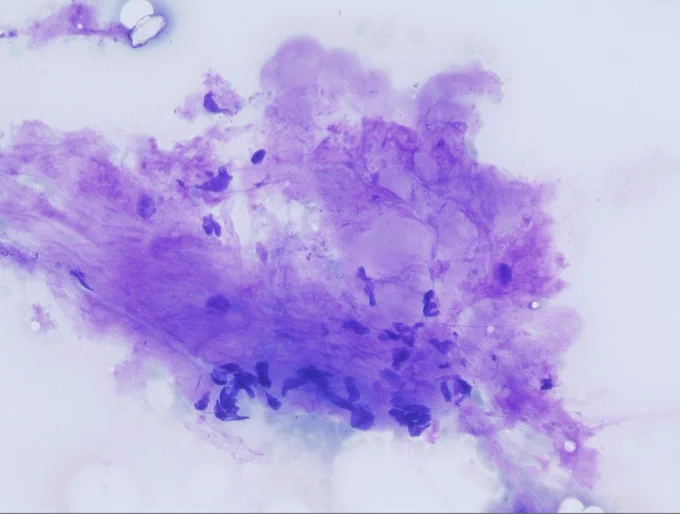 A hypocellular tissue fragment with delicate fibrillary stroma and focal elongated nuclei (Giemsa). @IARCWHO