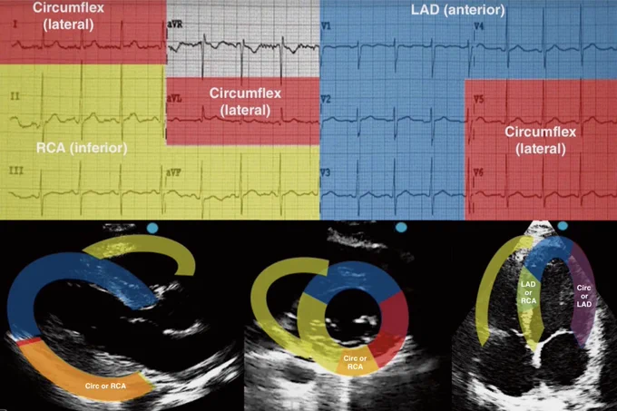 LAD-left anterior descending artery; Circ- left circumflex artery; RCA-right coronary artery.