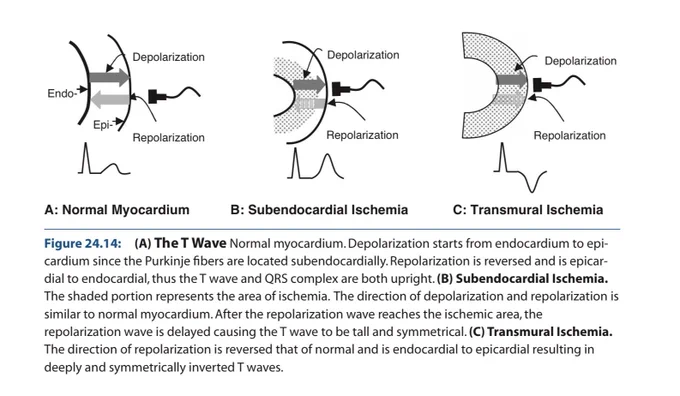 Source : Basic & Bedside ECG & Marriot electrocardiography