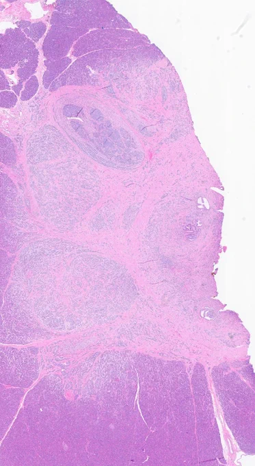 Sclerotic tumor arising adjacent to a large pancreatic duct. @IARCWHO