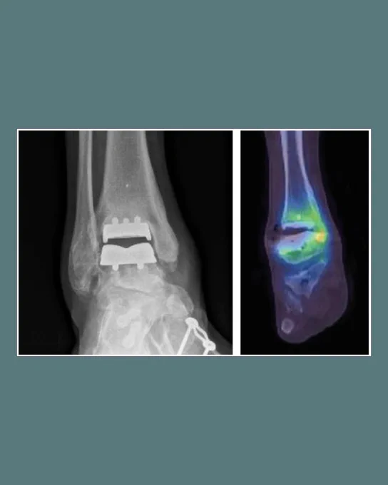 a) Anteroposterior radiograph of ankle arthroplasty in a 78-year-old male patient presenting with medial-sided pain. b) Coronal cut single-photon emission CT showing increased uptake at medial gutter corresponding to impingement symptoms.
