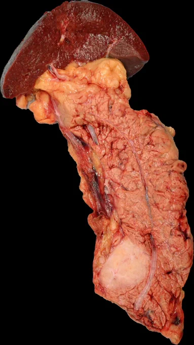Well-demarcated solid tumor in the pancreatic body @IARCWHO