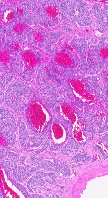 Tumor with solid nested pattern @IARCWHO