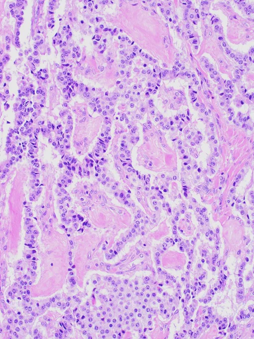 Gyriform-trabecular pattern @IARCWHO