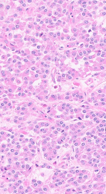 Some variants may exhibit oncocytic morphology with abundant eosinophilic cytoplasm while maintaining a neuroendocrine nuclear profile.