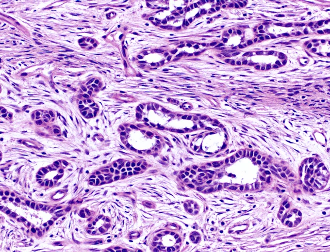 A 30-year-old male presents with a slow-growing, painful mass in his lower leg. Imaging reveals a soap bubble osteolytic lesion in the anterior tibial cortex. Neoplastic epithelial cells forming tubular structures @IARCWHO