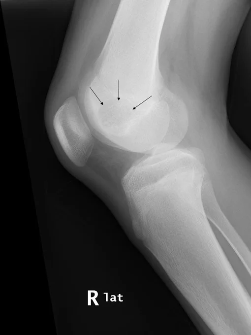Lateral radiograph showing a lytic lesion in the distal femoral epiphysis @IARCWHO