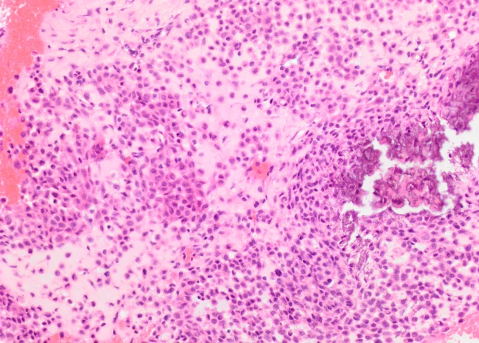 Sheets of chondroblastic oval to polygonal cells and osteoclast-like giant cells @IARCWHO
