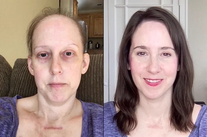 Me in 2017 in treatment versus me in 2021 in remission