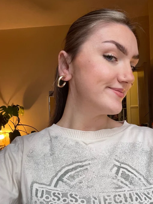 Abi today in her early twenties, her swelling has gone and you can see slight scarring. She shares confidently with the camera by tilting her neck towards it and smiling. 