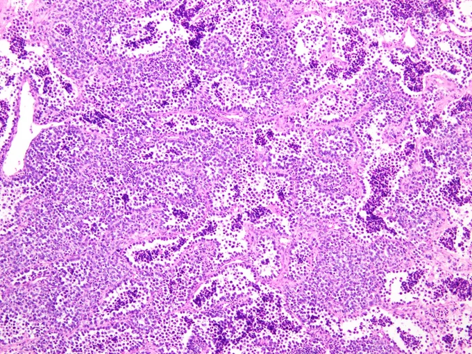 A 19-year-old male presents with a rapidly growing deep soft tissue mass in his forearm. Biopsy shows primitive cells in a nested arrangement. A proliferation of tumor cells with the characteristic alveolar growth pattern @IARCWHO
