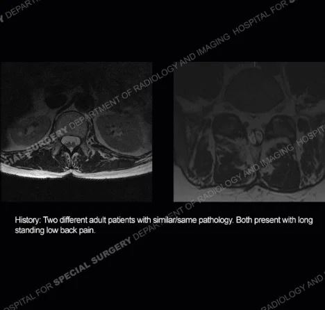 History: Two different adult patients with similar/same pathology. Both present with long standing low back pain.