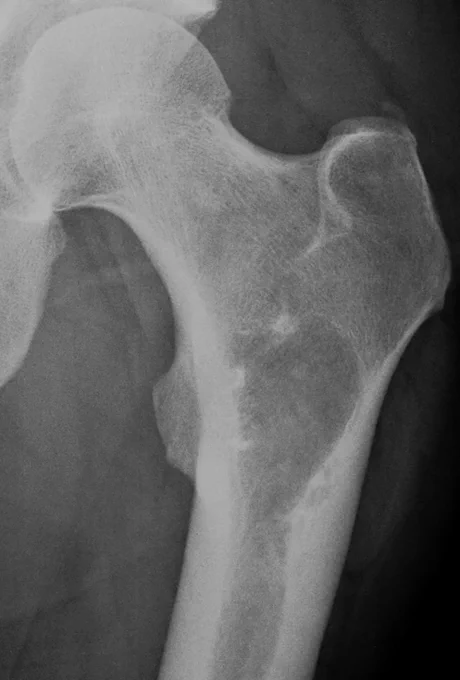 A 50-year-old male presents with persistent aching pain in his heel bone. Well-circumscribed oval radiolucency with calcifications @IARCWHO