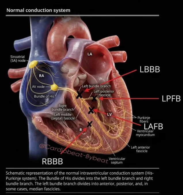 His‑Purkinje System: Anatomical Basis of Conduction Blocks

Synchronized ventricular activation depends on the His‑Purkinje network. The Bundle of His divides into the right bundle branch and the left bundle branch—the latter typically splitting into anterior and posterior fascicles (with a variable median fascicle). Lesions at any level produce distinct ECG patterns: bundle branch blocks and fascicular (hemi)blocks, essential tools for localization.

#Cardiology #EPeep #ECG #ConductionSystem #BundleBranchBlock