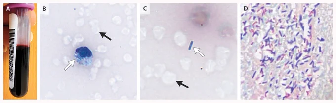 Panel A: Photo of the specimen.  

Panels B and C: A postmortem review of a peripheral-blood smear showing numerous dehemoglobinized red cells with intracellular and extracellular bacilli.  

Panel D: Cardiac tissue showing numerous gram-positive and gram-negative bacilli, with gram-positive organisms predominating. 