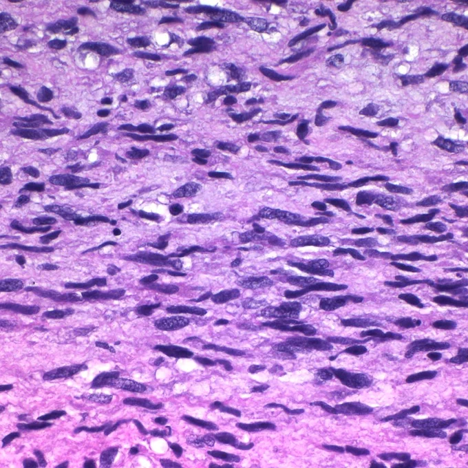 A 42-year-old male with neurofibromatosis type 1 presents with a rapidly enlarging, painful mass in his deep gluteal region. High power view demonstrating the spindle shaped and wavy nuclei characteristic of this tumor @IARCWHO