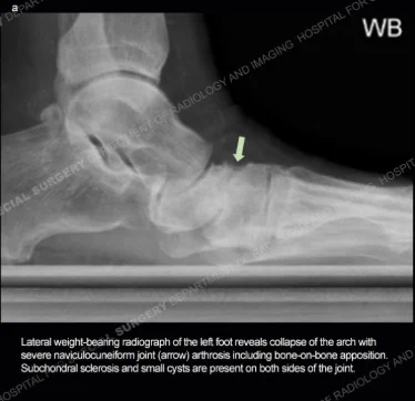 Lateral weight-bearing radiograph of the left foot reveals collapse of the arch with severe naviculocuneiform joint (arrow) arthrosis including bone-on-bone apposition. Subchondral sclerosis and small cysts are present on both sides of the joint.