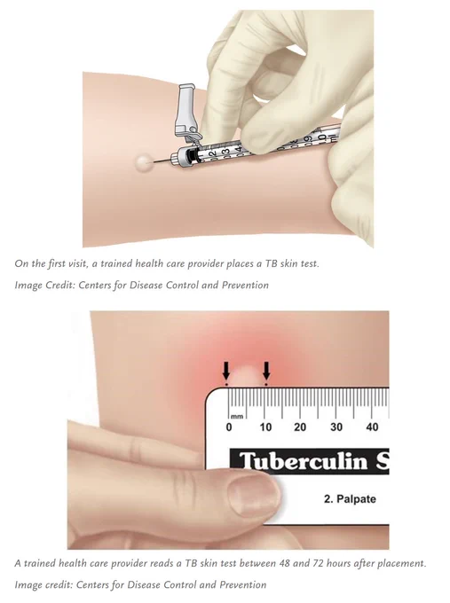 Top: On the first visit, a trained health care provider places a TB skin test.
Image Credit: Centers for Disease Control and Prevention

Bottom: A trained health care provider reads a TB skin test between 48 and 72 hours after placement.
Image credit: Centers for Disease Control and Prevention