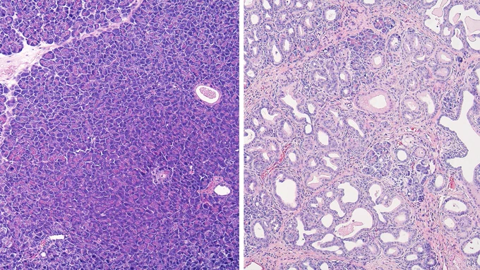 Microscopic tissue images of a healthy pancreas on the left and a diseased pancreas on the right