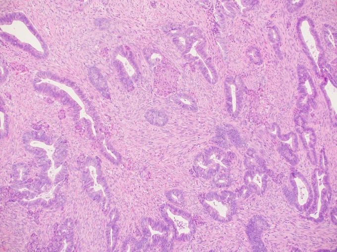 A 39-year-old woman presents with infertility and a 2 cm polypoid mass in the lower uterine segment. These lesions typically contain irregular, often architecturally complex endometrioid glands, often with squamous morules, set within myomatous or fibromyomatous stroma. @IARCWHO
