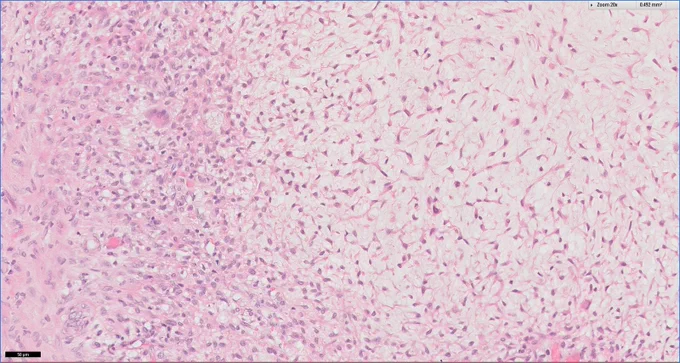A 22-year-old male presents with chronic pain in his proximal tibia. Imaging shows an eccentric, metaphyseal, lobulated lytic lesion with a sclerotic margin. Stellate cells embedded in a myxoid matrix are seen on the right with more cellular areas containing round cells on the left @IARCWHO