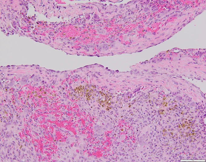 An 11-year-old female presents with an expansile tibial lesion showing multiple fluid-fluid levels on MRI. Cyst wall showing lack of distinctive cell lining and composed of spindle cells with scattered giant cells and hemorrhage @IARCWHO