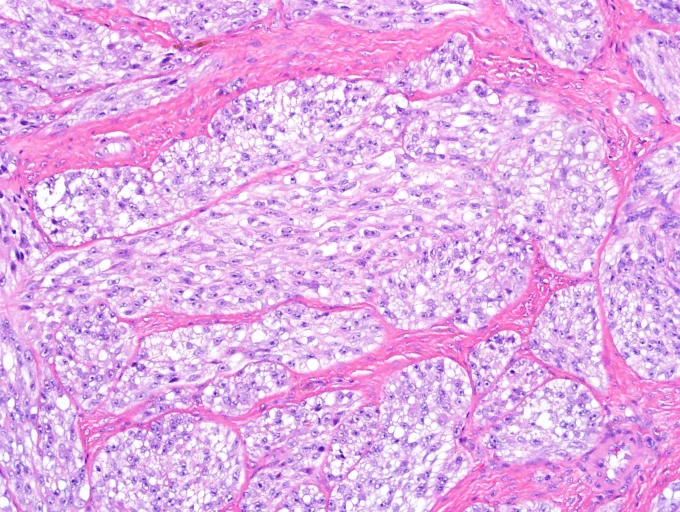 A 24-year-old female presents with a longstanding mass in her foot involving the plantaris tendon. Cords and nests of epithelioid cells with pale cytoplasm and prominent macronucleoli @IARCWHO
