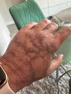 Charlotte's hand, showing burn scarring.