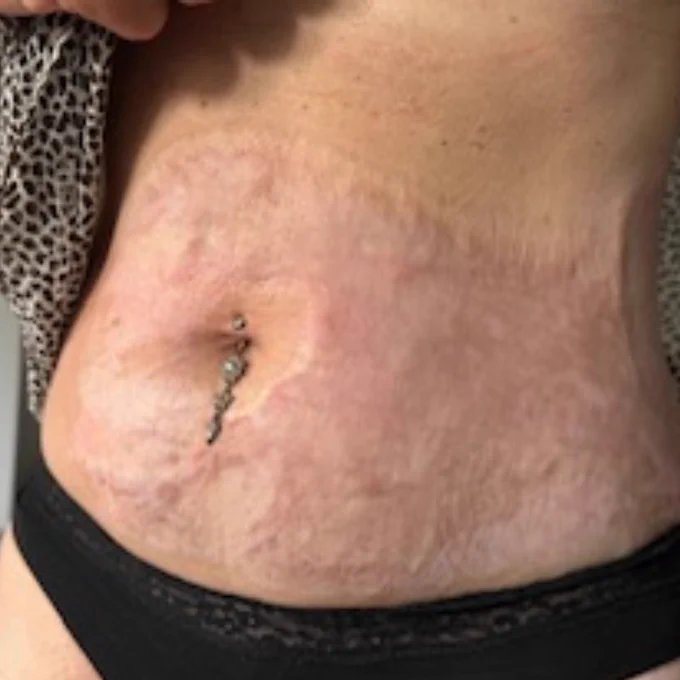 Charlotte's stomach showing burn scarring