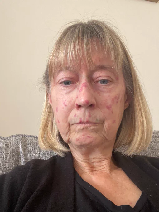 Janelle without makeup on, at home on the sofa, sharing a clear image of her skin condition, which presents as small red dots across her face.