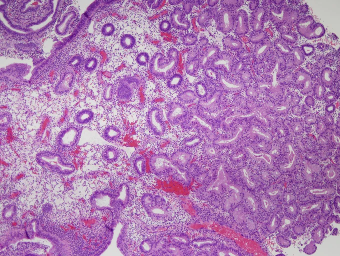 The geographical region is visible at low magnification: its architecture shows aggregates of glands that exceed the volume of stroma. @IARCWHO