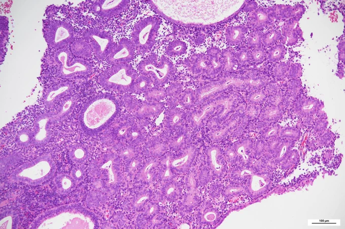
Densely packed endometrial glands with little intervening stroma. @IARCWHO