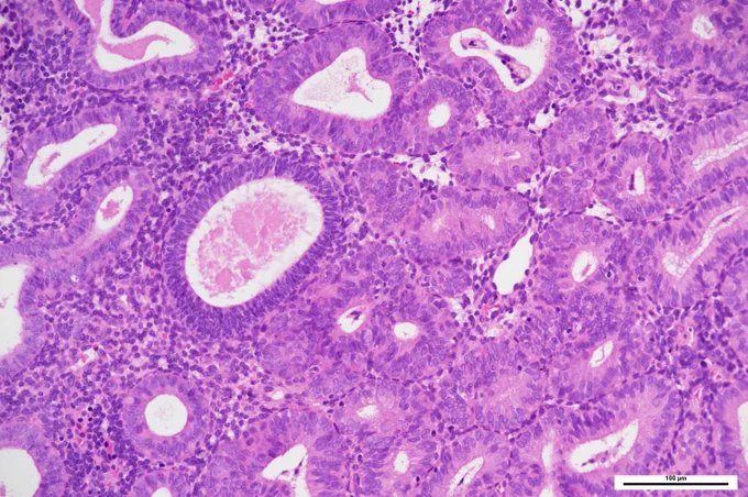 
The nuclear and cytoplasmic features of the crowded glands differ from those of the entrapped non-atypical gland. @IARCWHO