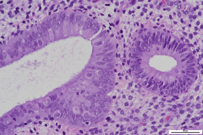 
The atypical gland with enlarged, irregularly distributed nuclei (left) is distinct from an adjacent non-lesional gland (right). @IARCWHO