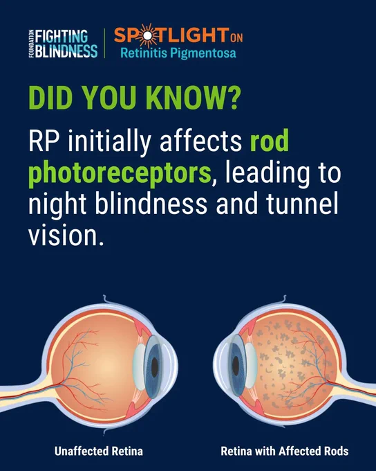Dark blue background with the Foundation Fighting Blindness and Spotlight on Retinitis Pigmentosa logos top-left. Text below that reads, "RP initially affects rod photoreceptors, leading to night blindness and tunnel vision." An illustration of two eyes below, the left showing an unaffected retina, the right showing a retina with affected rods.