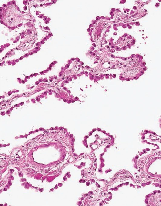 NORMAL CHOROID PLEXUS:
The regular cell spacing and hobnail appearance of normal choroid plexus distinguishes it from choroid plexus papilloma.