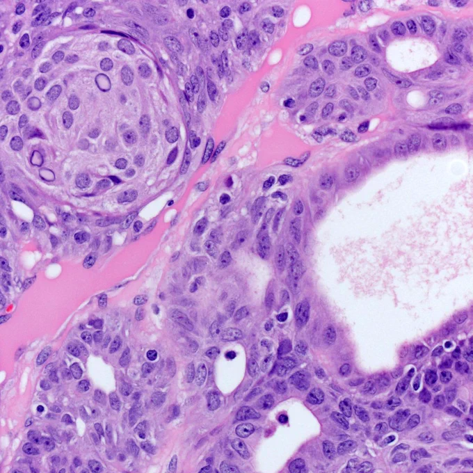 A 28-year-old woman presents with a well-circumscribed thyroid mass showing an admixture of cribriform and squamoid morular patterns. Morule and cribriform tubular growth patterns without intervening fibrous stroma @IARCWHO