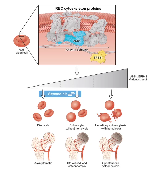 Diagram showing ANK1 and EPB41 as susceptible genes for SONFH.
The effects of ANK1 and EPB41 variants lie on a phenotypic spectrum, ranging from nondamaging, asymptomatic on one end of the spectrum, to severe clinical hemolytic anemia on the other end of the spectrum. The variants identified in our study represent a milder intermediate phenotype. The carriers of a single altered copy (heterozygous state) demonstrate increased osmotic fragility and reduced red blood cell deformability compared to non-carriers, which does not produce hemolysis or anemia but represents a subclinical phenotype. However, this partial impairment appears sufficient to predispose individuals to the development of osteonecrosis in the presence of the second hit (i.e., corticosteroid exposure).
