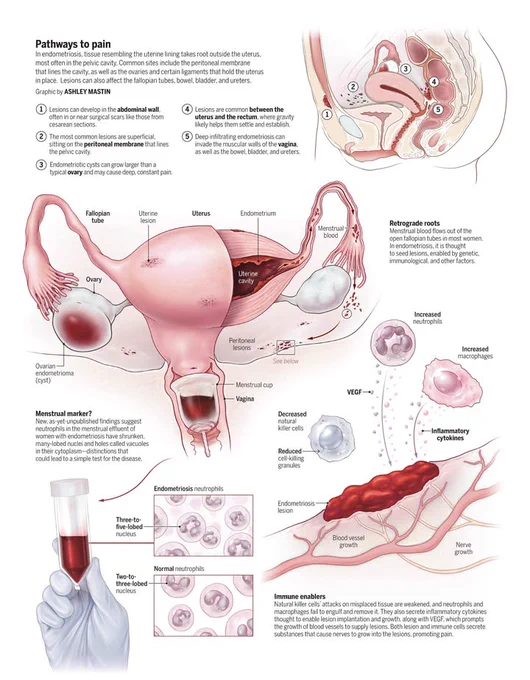 Pathways to pain: graphic illustrating the symptoms and mechanisms of endometriosis. Panel 1: diagram of the pelvic area showing common locations of lesions and cysts: the abdominal wall, the peritoneal membrane, the ovaries, between the uterus and rectum, and the vagina. Panel 2: Illustration of a reproductive system with endometriosis, showing locations of lesions and an ovarian cyst, as well as menstrual blood flowing out of the fallopian tube, which is thought to seed lesions. Panel 3: comparison of neutrophils in the menstrual effluent (ME) of women with endometriosis versus without; with endometriosis, the neutrophils have shrunken, many-lobed nuclei and vacuoles in their cytoplasm. Panel 4: Illustration of immune factors involved in endometriosis lesions: decreased natural killer cells, and increased neutrophils and macrophages.