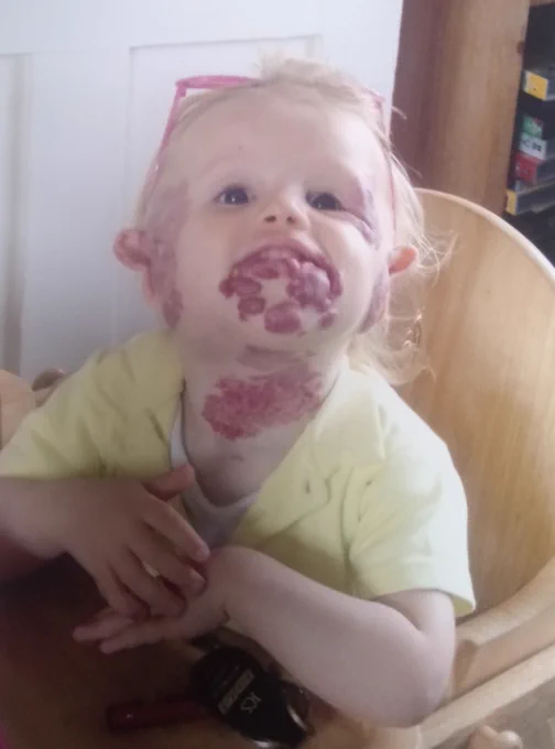 Rose as a toddler, she has raised birthmarks on her neck, ear, chin and cheek. she is a happy blonde baby smiling at the camera.