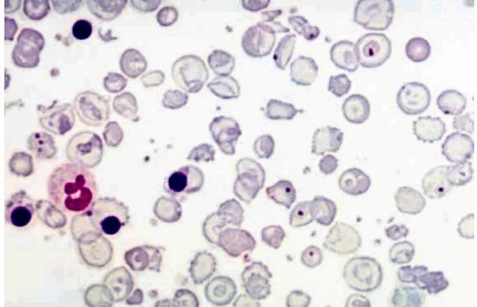There are hypochromic cells, target cells and manynucleated red cells (normoblasts).Howell –Jolly bodies are seen insame red cells.