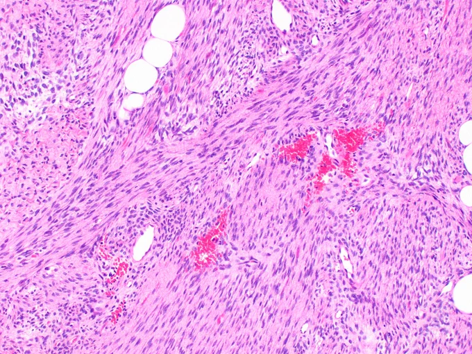 A 3-month-old infant presents with a rapidly enlarging, painless soft tissue mass in the forearm. Highly cellular spindle cell neoplasm showing long intersecting fascicles in a herringbone pattern @IARCWHO
