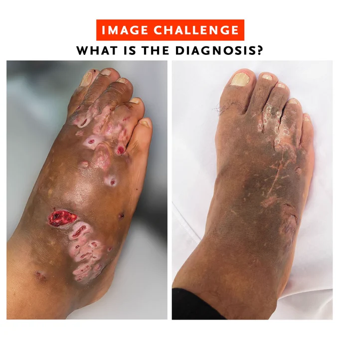 Image Challenge
What is the diagnosis?

Photos of the right foot taken at presentation (left) and after treatment (right)
